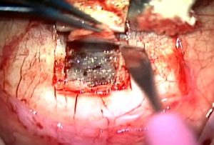 La cirugía minimalista se practica en la parte superior del ojo, debajo del párpado. La microcicatriz permanece oculta. 