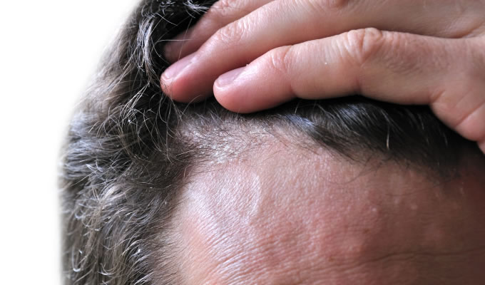 Tipos de dermatitis en el cuero cabelludo