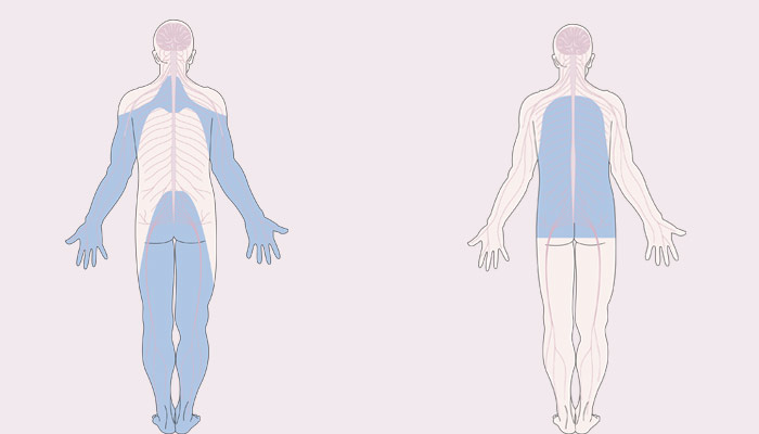 polineuropatía síntomas de diabetes polineuropatía síntomas de diabetes