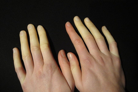 1024px Raynaud Syndrom