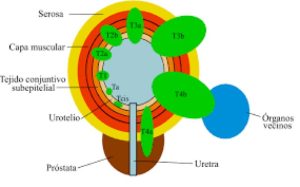 cáncer de próstata