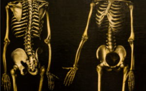 osteoporosis