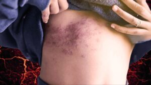 herpes zoster