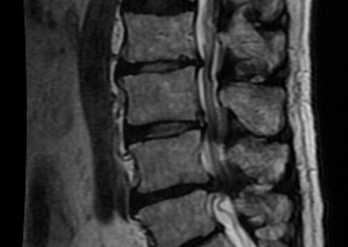 Un estudio revela que el tejido de la médula espinal humana cultivado en laboratorio muestra signos de reparación tras una lesión.