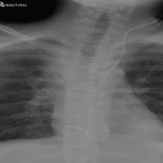 Si un niño tiene dolor de espalda hay que prestar atención porque puede ser síntoma de un cáncer óseo